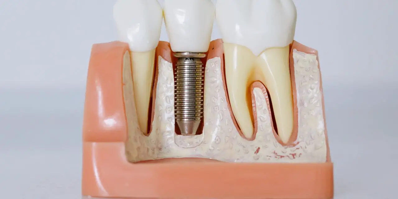 How Long Can You Keep Your Teeth With Periodontal Disease?